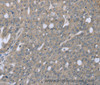 Immunohistochemistry of paraffin-embedded Human ovarian cancer tissue using BMX Polyclonal Antibody at dilution 1:30