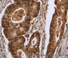 Immunohistochemistry of paraffin-embedded Human colon cancer tissue using EXTL3 Polyclonal Antibody at dilution 1:30