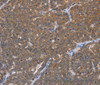 Immunohistochemistry of paraffin-embedded Human ovarian cancer using FABP6 Polyclonal Antibody at dilution of 1:30