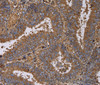 Immunohistochemistry of paraffin-embedded Human colon cancer using FADS1 Polyclonal Antibody at dilution of 1:60