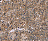 Immunohistochemistry of paraffin-embedded Human liver cancer tissue using FAM107A Polyclonal Antibody at dilution 1:30