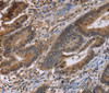 Immunohistochemistry of paraffin-embedded Human colon cancer tissue using FAM107A Polyclonal Antibody at dilution 1:30