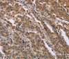 Immunohistochemistry of paraffin-embedded Human liver cancer tissue using FAM3B Polyclonal Antibody at dilution 1:40