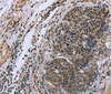 Immunohistochemistry of paraffin-embedded Human cervical cancer tissue using FANCG Polyclonal Antibody at dilution 1:50