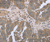 Immunohistochemistry of paraffin-embedded Human ovarian cancer tissue using FANCG Polyclonal Antibody at dilution 1:50