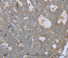 Immunohistochemistry of paraffin-embedded Human ovarian cancer tissue using FAR2 Polyclonal Antibody at dilution 1:40
