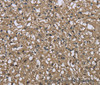 Immunohistochemistry of paraffin-embedded Human prostate cancer using FBP1 Polyclonal Antibody at dilution of 1:40
