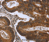 Immunohistochemistry of paraffin-embedded Human colon cancer tissue using FGFR1OP Polyclonal Antibody at dilution 1:50