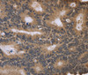 Immunohistochemistry of paraffin-embedded Human colon cancer tissue using FGFR1OP2 Polyclonal Antibody at dilution 1:40