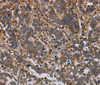 Immunohistochemistry of paraffin-embedded Human liver cancer using FLNA Polyclonal Antibody at dilution of 1:40