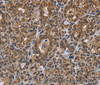 Immunohistochemistry of paraffin-embedded Human thyroid cancer using GALK1 Polyclonal Antibody at dilution of 1:40