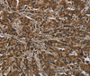 Immunohistochemistry of paraffin-embedded Human liver cancer tissue using PIP Polyclonal Antibody at dilution 1:50