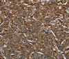 Immunohistochemistry of paraffin-embedded Human liver cancer using ARHGDIA Polyclonal Antibody at dilution of 1:30