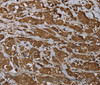 Immunohistochemistry of paraffin-embedded Human breast cancer using ARHGDIA Polyclonal Antibody at dilution of 1:30