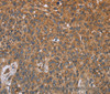 Immunohistochemistry of paraffin-embedded Human lung cancer using GH2 Polyclonal Antibody at dilution of 1:40