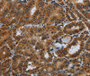 Immunohistochemistry of paraffin-embedded Human thyroid cancer tissue using Glucocorticoid Receptor Polyclonal Antibody at dilution 1:40