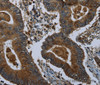 Immunohistochemistry of paraffin-embedded Human colon cancer using GLUL Polyclonal Antibody at dilution of 1:60