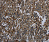 Immunohistochemistry of paraffin-embedded Human liver cancer using GLUL Polyclonal Antibody at dilution of 1:60