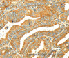 Immunohistochemistry of paraffin-embedded Human colon cancer tissue using GK1 Polyclonal Antibody at dilution 1:60