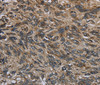 Immunohistochemistry of paraffin-embedded Human esophagus cancer tissue using CD236 Polyclonal Antibody at dilution 1:60