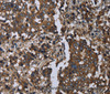 Immunohistochemistry of paraffin-embedded Human liver cancer using GOLGA2 Polyclonal Antibody at dilution of 1:60