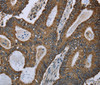Immunohistochemistry of paraffin-embedded Human colon cancer using GOT2 Polyclonal Antibody at dilution of 1:50