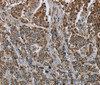 Immunohistochemistry of paraffin-embedded Human liver cancer using GOT2 Polyclonal Antibody at dilution of 1:50