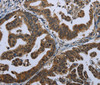 Immunohistochemistry of paraffin-embedded Human gastric cancer tissue using GPAM Polyclonal Antibody at dilution 1:60