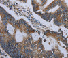 Immunohistochemistry of paraffin-embedded Human colon cancer using NDUFA13 Polyclonal Antibody at dilution of 1:50
