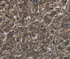 Immunohistochemistry of paraffin-embedded Human liver cancer using Histone H4 Polyclonal Antibody at dilution of 1:30
