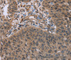 Immunohistochemistry of paraffin-embedded Human lung cancer using HOMER1 Polyclonal Antibody at dilution of 1:50