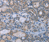 Immunohistochemistry of paraffin-embedded Human thyroid cancer using HOMER1 Polyclonal Antibody at dilution of 1:50