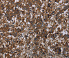 Immunohistochemistry of paraffin-embedded Human liver cancer tissue using HOMER2 Polyclonal Antibody at dilution 1:40