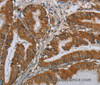 Immunohistochemistry of paraffin-embedded Human esophagus cancer using CSH1 Polyclonal Antibody at dilution of 1:40