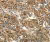 Immunohistochemistry of paraffin-embedded Human liver cancer using HSD17B8 Polyclonal Antibody at dilution of 1:55