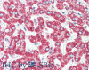 Immunohistochemistry of paraffin-embedded Human liver cancer using HSD17B8 Polyclonal Antibody at dilution of 1:100(Elabscience® Product Detected by Lifespan).