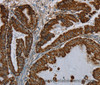 Immunohistochemistry of paraffin-embedded Human esophagus cancer using HSD17B2 Polyclonal Antibody at dilution of 1:50
