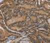 Immunohistochemistry of paraffin-embedded Human thyroid cancer using HSP40-4 Polyclonal Antibody at dilution of 1:60