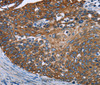 Immunohistochemistry of paraffin-embedded Human cervical cancer tissue using FCGR3A Polyclonal Antibody at dilution 1:40