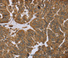 Immunohistochemistry of paraffin-embedded Human ovarian cancer tissue using IKBIP Polyclonal Antibody at dilution 1:40