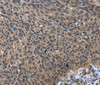 Immunohistochemistry of paraffin-embedded Human lung cancer using IMPDH2 Polyclonal Antibody at dilution of 1:60