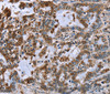 Immunohistochemistry of paraffin-embedded Human liver cancer using IMPDH2 Polyclonal Antibody at dilution of 1:60