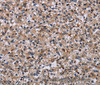Immunohistochemistry of paraffin-embedded Human prostate cancer using IPO4 Polyclonal Antibody at dilution of 1:50