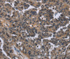 Immunohistochemistry of paraffin-embedded Human ovarian cancer using ITGAE Polyclonal Antibody at dilution of 1:50