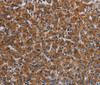 Immunohistochemistry of paraffin-embedded Human prostate cancer tissue using IRGM Polyclonal Antibody at dilution 1:50