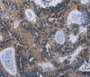 Immunohistochemistry of paraffin-embedded Human colon cancer tissue using IRGM Polyclonal Antibody at dilution 1:50