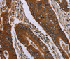 Immunohistochemistry of paraffin-embedded Human colon cancer using Catenin gamma Polyclonal Antibody at dilution of 1:40