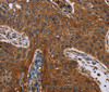 Immunohistochemistry of paraffin-embedded Human lung cancer using Catenin gamma Polyclonal Antibody at dilution of 1:40