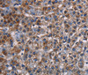 Immunohistochemistry of paraffin-embedded Human lung cancer tissue using KCNK1 Polyclonal Antibody at dilution 1:50