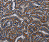 Immunohistochemistry of paraffin-embedded Human thyroid cancer tissue using KLK11 Polyclonal Antibody at dilution 1:40